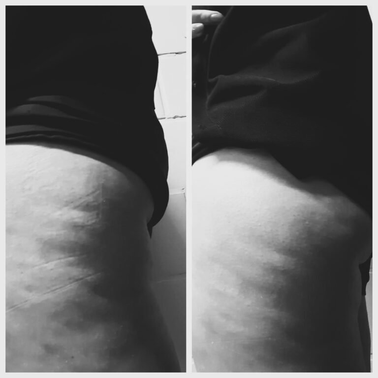 Diensten Massagetherapie Sport & Ontspanning. Anti-sellulite kuur behandeling benen Cupping