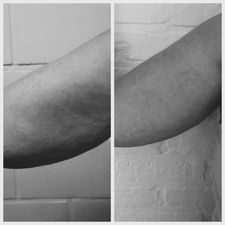 Diensten Massagetherapie Sport & Ontspanning. Anti-cellulite kuur behandeling armen cupping